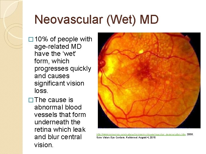 Neovascular (Wet) MD � 10% of people with age-related MD have the ‘wet’ form,