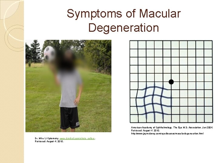 Symptoms of Macular Degeneration American Academy of Ophthalmology. The Eye M. D. Association, Jan