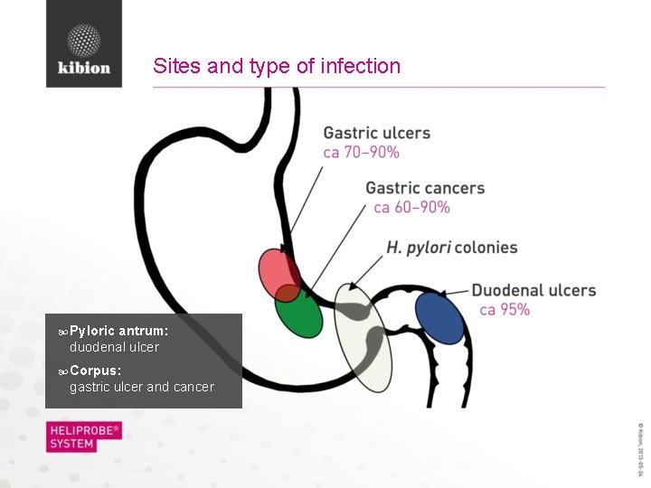 Sites and type of infection Pyloric antrum: duodenal ulcer Corpus: gastric ulcer and cancer
