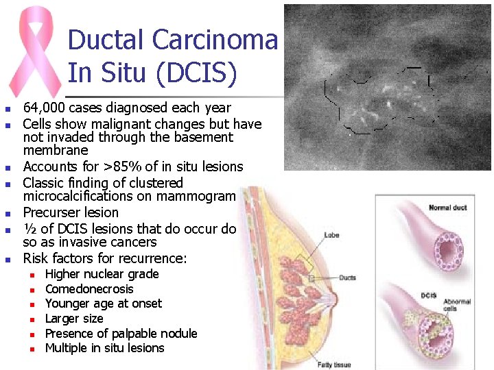 Ductal Carcinoma In Situ (DCIS) n n n n 64, 000 cases diagnosed each