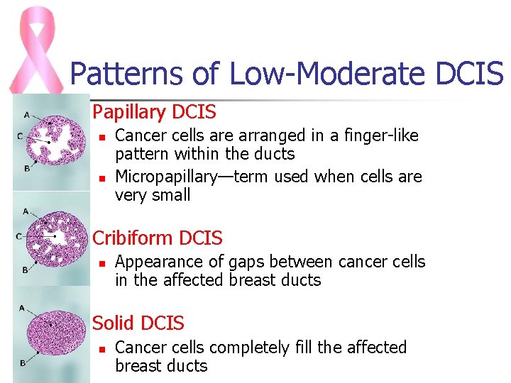 Patterns of Low-Moderate DCIS n Papillary DCIS n n n Cribiform DCIS n n