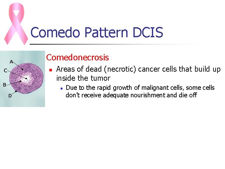 Comedo Pattern DCIS n Comedonecrosis n Areas of dead (necrotic) cancer cells that build