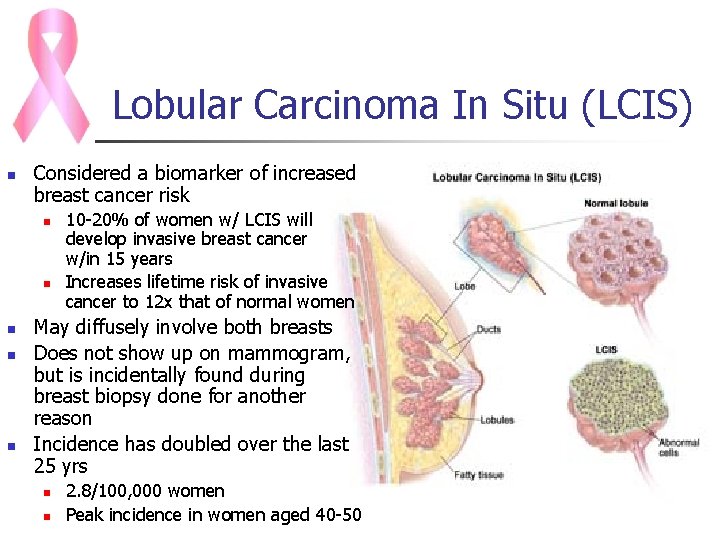 Lobular Carcinoma In Situ (LCIS) n Considered a biomarker of increased breast cancer risk