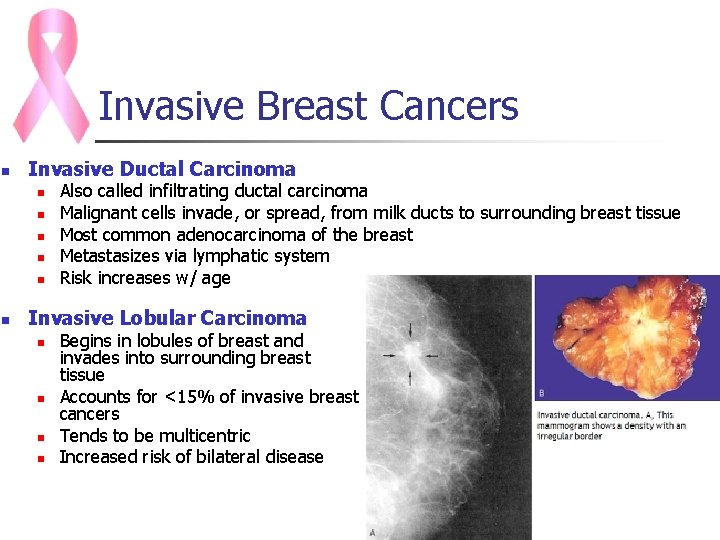 Invasive Breast Cancers n Invasive Ductal Carcinoma n n n Also called infiltrating ductal