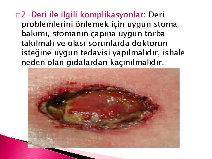 � 2 -Deri ile ilgili komplikasyonlar: Deri problemlerini önlemek için uygun stoma bakımı, stomanın