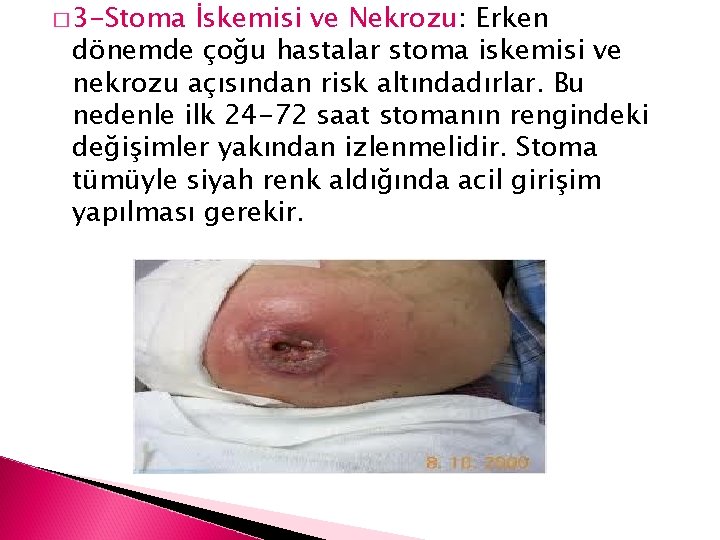 � 3 -Stoma İskemisi ve Nekrozu: Erken dönemde çoğu hastalar stoma iskemisi ve nekrozu