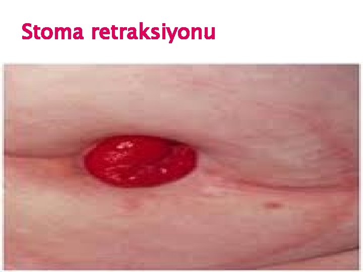 Stoma retraksiyonu 