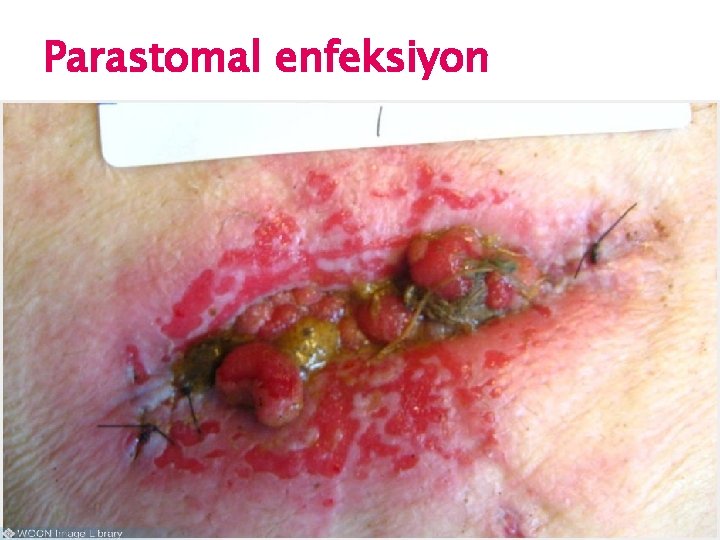 Parastomal enfeksiyon 