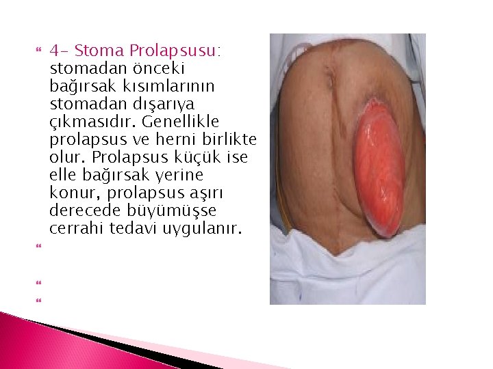  4 - Stoma Prolapsusu: stomadan önceki bağırsak kısımlarının stomadan dışarıya çıkmasıdır. Genellikle prolapsus