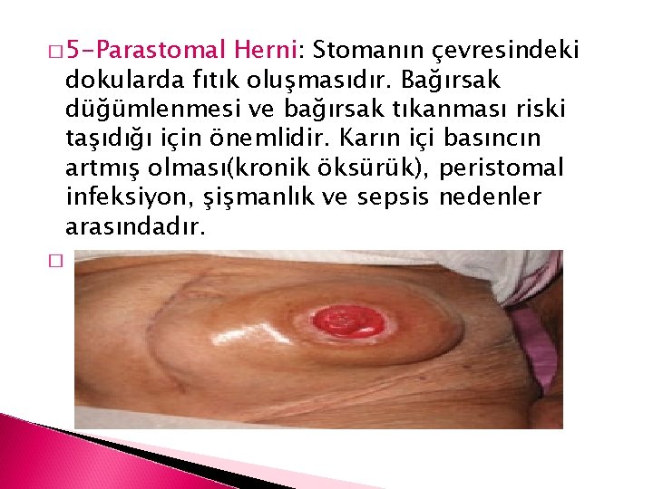 � 5 -Parastomal Herni: Stomanın çevresindeki dokularda fıtık oluşmasıdır. Bağırsak düğümlenmesi ve bağırsak tıkanması