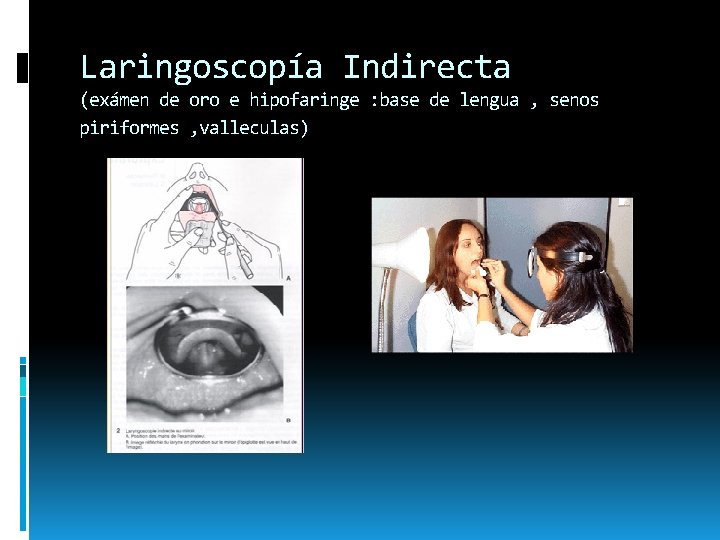 Laringoscopía Indirecta (exámen de oro e hipofaringe : base de lengua , senos piriformes Laringoscopía Indirecta (exámen de oro e hipofaringe : base de lengua , senos piriformes