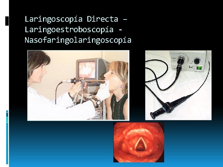 Laringoscopía Directa – Laringoestroboscopía Nasofaringolaringoscopía Laringoscopía Directa – Laringoestroboscopía Nasofaringolaringoscopía