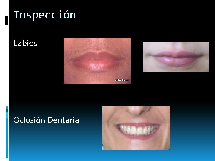 Inspección Labios Oclusión Dentaria Inspección Labios Oclusión Dentaria