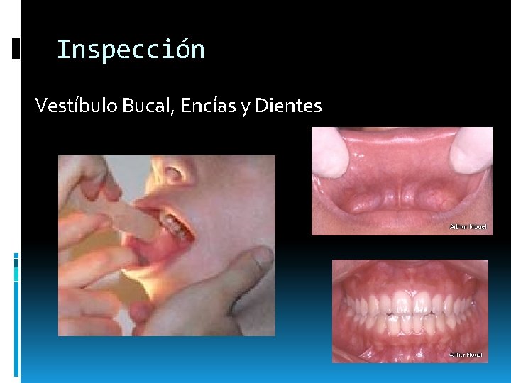 Inspección Vestíbulo Bucal, Encías y Dientes Inspección Vestíbulo Bucal, Encías y Dientes