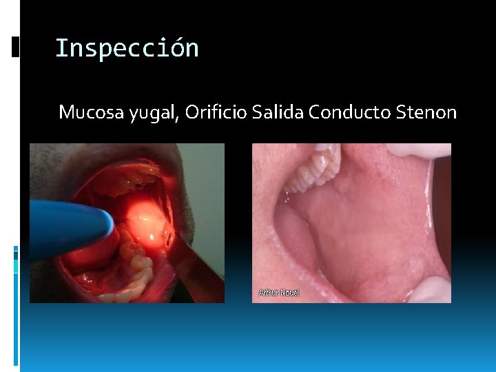 Inspección Mucosa yugal, Orificio Salida Conducto Stenon Inspección Mucosa yugal, Orificio Salida Conducto Stenon