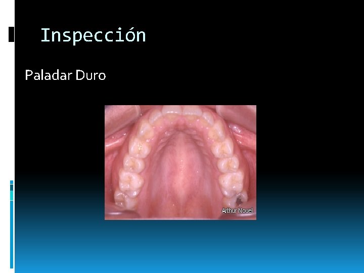 Inspección Paladar Duro Inspección Paladar Duro