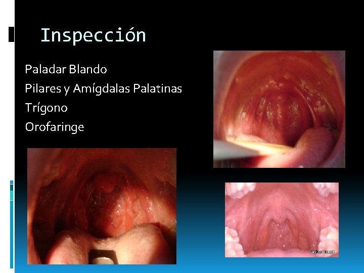 Inspección Paladar Blando Pilares y Amígdalas Palatinas Trígono Orofaringe Inspección Paladar Blando Pilares y Amígdalas Palatinas Trígono Orofaringe