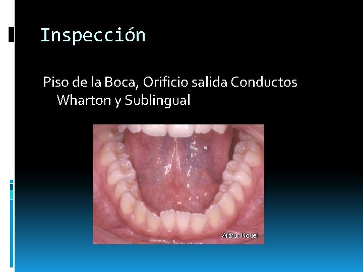 Inspección Piso de la Boca, Orificio salida Conductos Wharton y Sublingual Inspección Piso de la Boca, Orificio salida Conductos Wharton y Sublingual