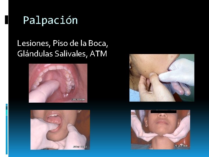 Palpación Lesiones, Piso de la Boca, Glándulas Salivales, ATM Palpación Lesiones, Piso de la Boca, Glándulas Salivales, ATM