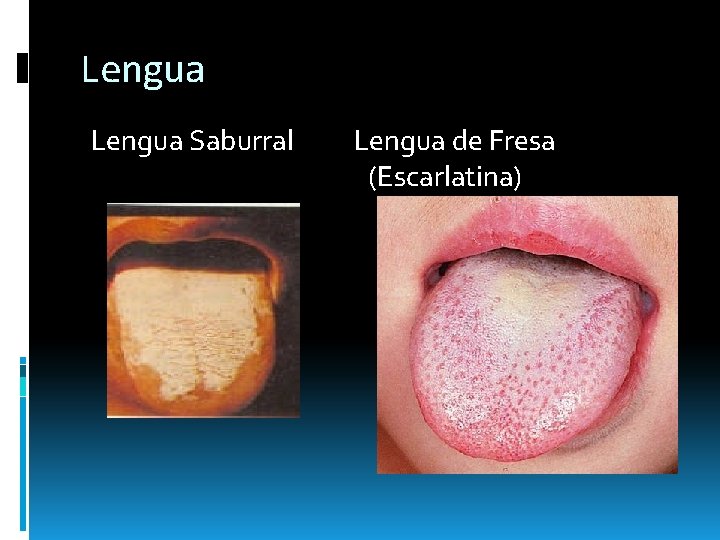 Lengua Saburral Lengua de Fresa (Escarlatina) Lengua Saburral Lengua de Fresa (Escarlatina)