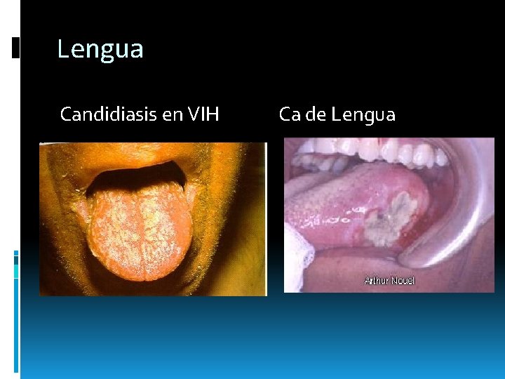 Lengua Candidiasis en VIH Ca de Lengua Lengua Candidiasis en VIH Ca de Lengua