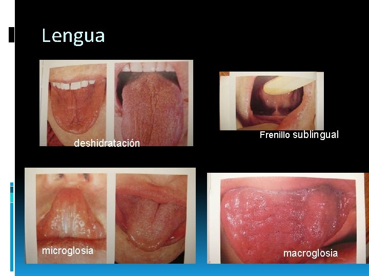 Lengua deshidratación microglosia Frenillo sublingual macroglosia Lengua deshidratación microglosia Frenillo sublingual macroglosia