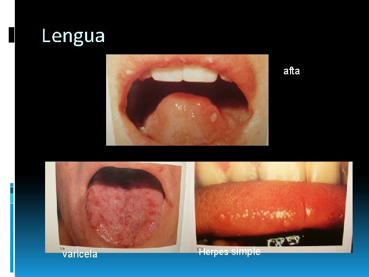 Lengua afta varicela Herpes simple Lengua afta varicela Herpes simple