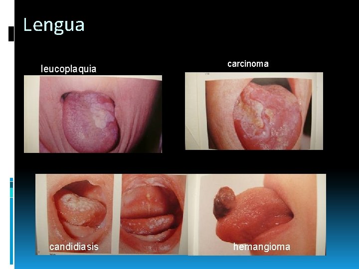 Lengua leucoplaquia candidiasis carcinoma hemangioma Lengua leucoplaquia candidiasis carcinoma hemangioma