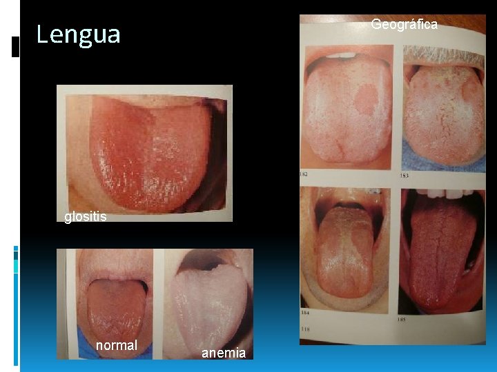 Geográfica Lengua glositis normal anemia Geográfica Lengua glositis normal anemia
