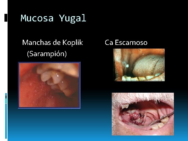 Mucosa Yugal Manchas de Koplik (Sarampión) Ca Escamoso Mucosa Yugal Manchas de Koplik (Sarampión) Ca Escamoso