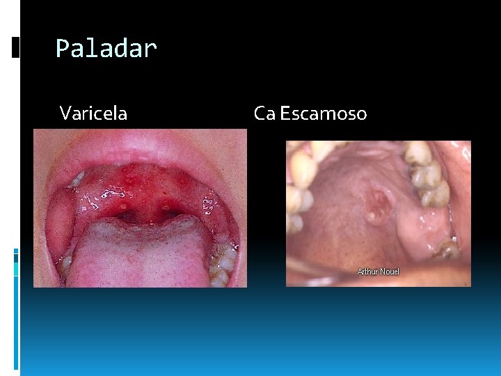 Paladar Varicela Ca Escamoso Paladar Varicela Ca Escamoso