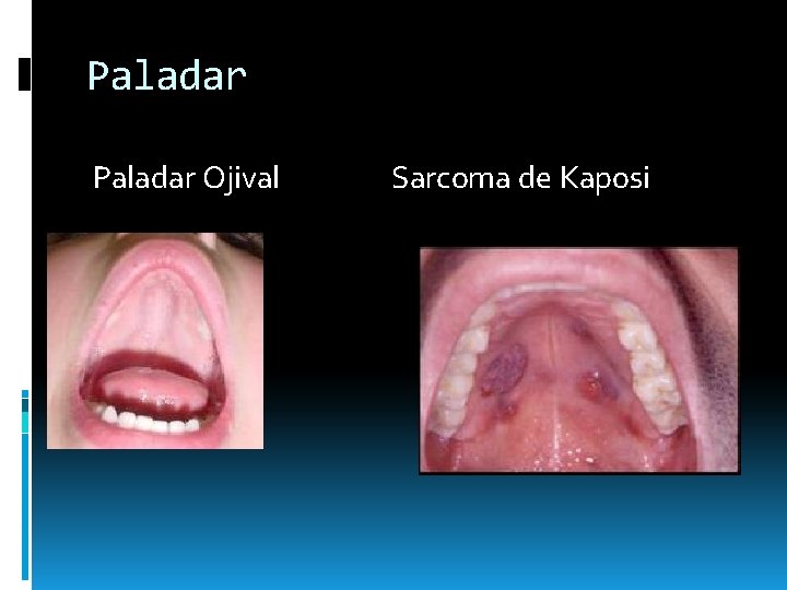 Paladar Ojival Sarcoma de Kaposi Paladar Ojival Sarcoma de Kaposi
