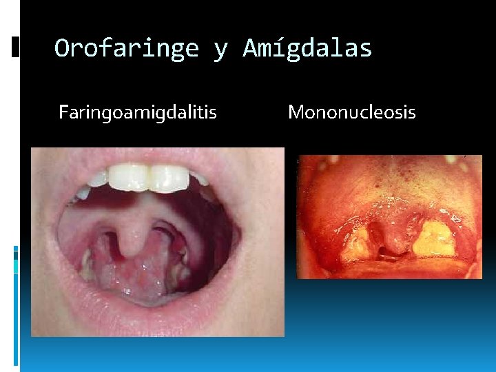 Orofaringe y Amígdalas Faringoamigdalitis Mononucleosis Orofaringe y Amígdalas Faringoamigdalitis Mononucleosis