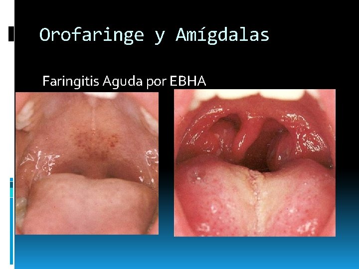 Orofaringe y Amígdalas Faringitis Aguda por EBHA Orofaringe y Amígdalas Faringitis Aguda por EBHA