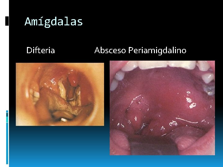 Amígdalas Difteria Absceso Periamigdalino Amígdalas Difteria Absceso Periamigdalino