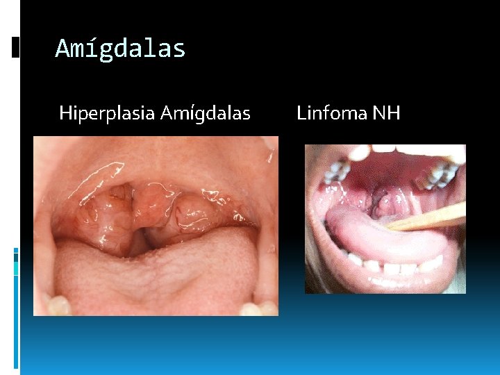 Amígdalas Hiperplasia Amígdalas Linfoma NH Amígdalas Hiperplasia Amígdalas Linfoma NH