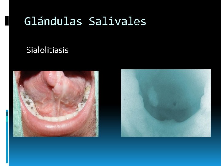 Glándulas Salivales Sialolitiasis Glándulas Salivales Sialolitiasis