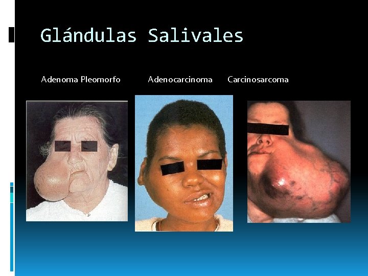 Glándulas Salivales Adenoma Pleomorfo Adenocarcinoma Carcinosarcoma Glándulas Salivales Adenoma Pleomorfo Adenocarcinoma Carcinosarcoma