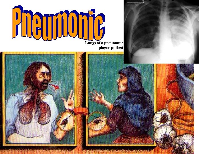 Lungs of a pneumonic plague patient 