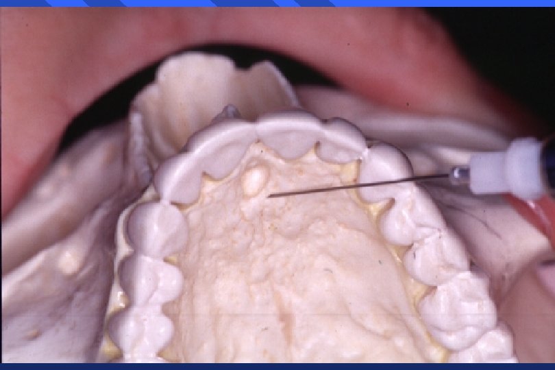 PALATAL ANESTHESIA Greater Palatine Nerve Block Anterior Palatine