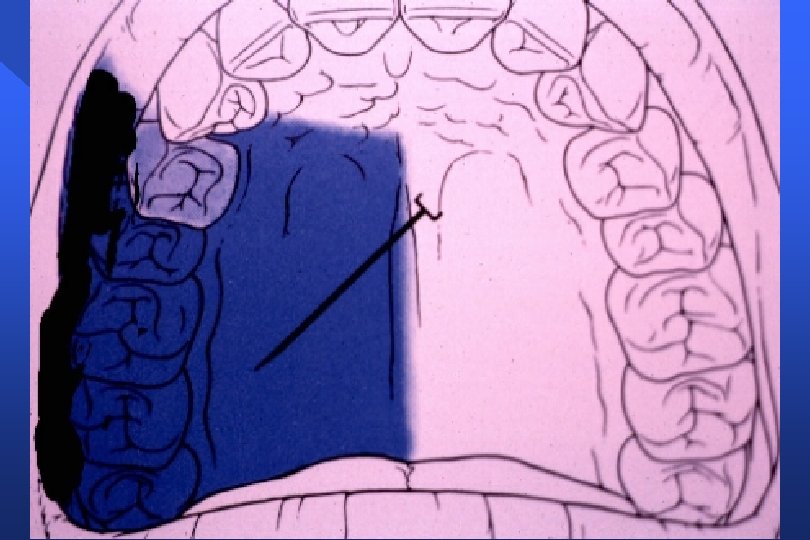 PALATAL ANESTHESIA Greater Palatine Nerve Block Anterior Palatine
