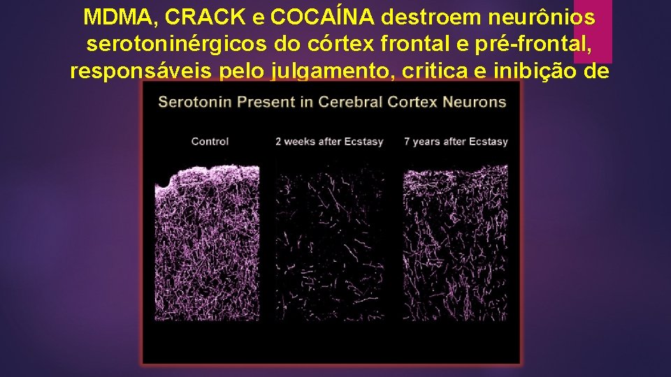 MDMA, CRACK e COCAÍNA destroem neurônios serotoninérgicos do córtex frontal e pré-frontal, responsáveis pelo MDMA, CRACK e COCAÍNA destroem neurônios serotoninérgicos do córtex frontal e pré-frontal, responsáveis pelo