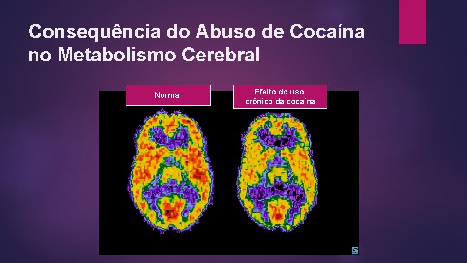 Consequência do Abuso de Cocaína no Metabolismo Cerebral Normal Efeito do uso crônico da Consequência do Abuso de Cocaína no Metabolismo Cerebral Normal Efeito do uso crônico da