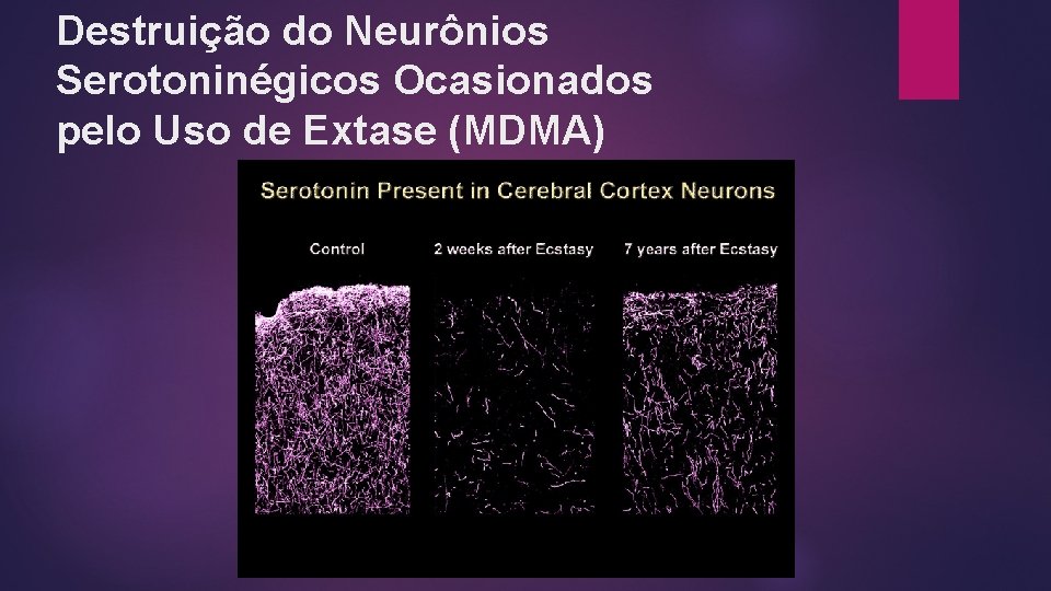 Destruição do Neurônios Serotoninégicos Ocasionados pelo Uso de Extase (MDMA) Destruição do Neurônios Serotoninégicos Ocasionados pelo Uso de Extase (MDMA)
