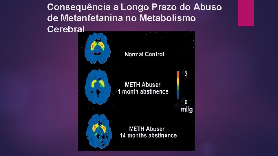 Consequência a Longo Prazo do Abuso de Metanfetanina no Metabolismo Cerebral Consequência a Longo Prazo do Abuso de Metanfetanina no Metabolismo Cerebral