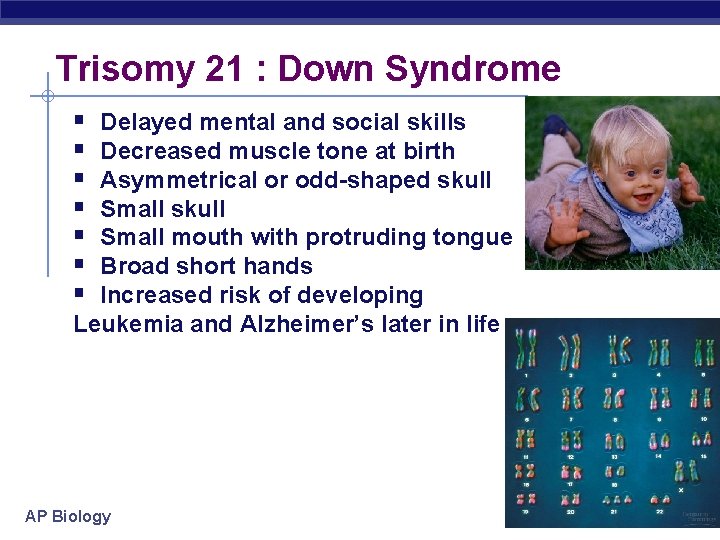 Trisomy 21 : Down Syndrome § § § § Delayed mental and social skills