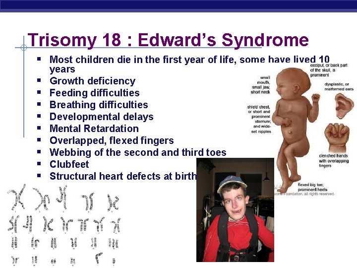 Trisomy 18 : Edward’s Syndrome § Most children die in the first year of
