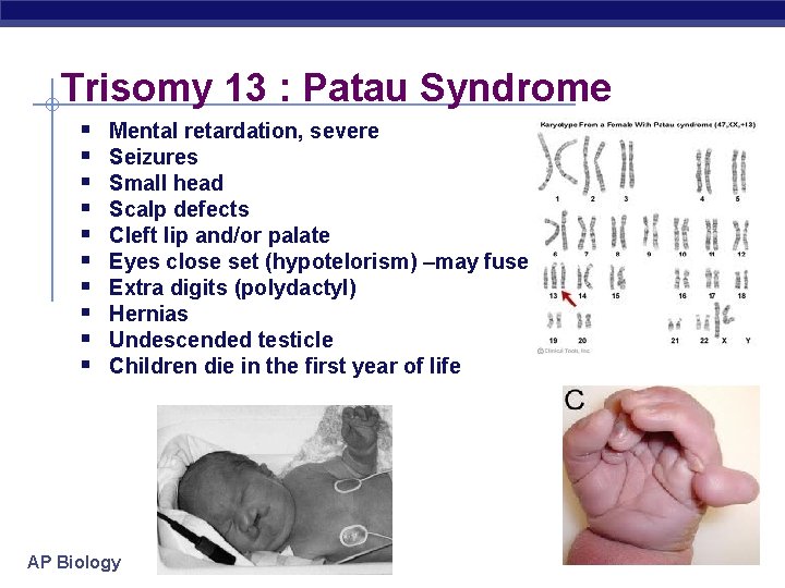 Trisomy 13 : Patau Syndrome § § § § § Mental retardation, severe Seizures