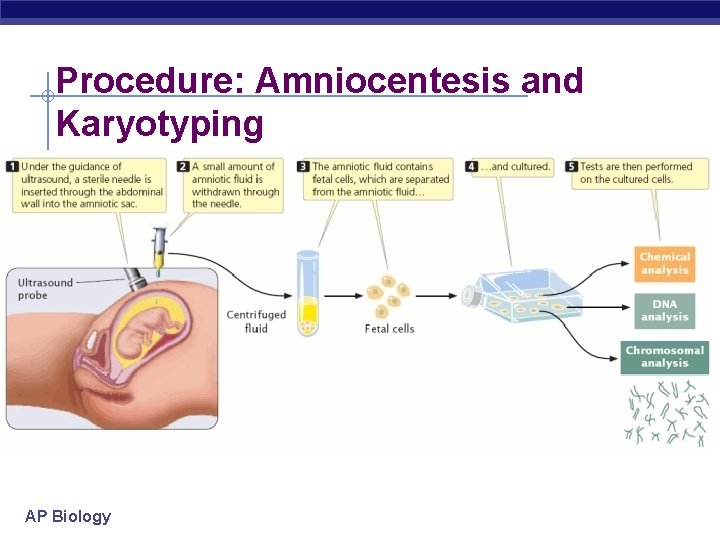 Procedure: Amniocentesis and Karyotyping AP Biology 