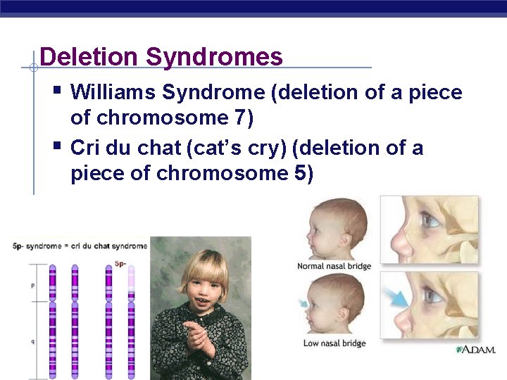Deletion Syndromes § Williams Syndrome (deletion of a piece § of chromosome 7) Cri